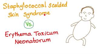 Staphylococcal Scalded Skin Syndrome VS Erythema Toxicum Neonatorum [upl. by Aihsram731]