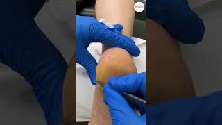 Heel callus removal [upl. by Arretahs]