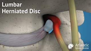 Lumbar Herniated Disc Overview [upl. by Tfat]