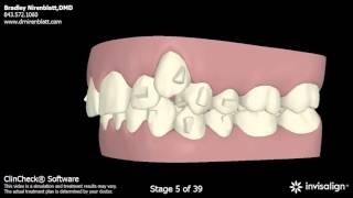 Invisalign Patients Before and After Nirenblatt Orthodontics [upl. by Todd]