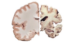 Alzheimers and the Brain [upl. by Haye556]