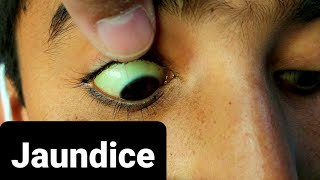 How Jaundice Looks Like [upl. by Woodberry]