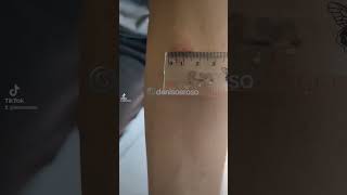 mantoux test positive lebih dari 10mm [upl. by Eissat]