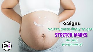 6 Signs Of Getting Stretch Marks During Pregnancy  Pregnancy Healthy Tips [upl. by Brabazon91]