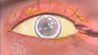 Cholesterol Deposits in the Eye The Doctors [upl. by Sset]