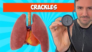 Fine and Coarse Crackles Lung Sounds For Beginners 🔥🔥🔥 [upl. by Amerak]