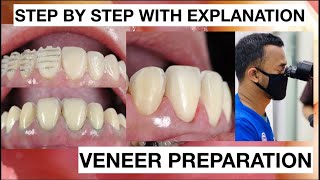 Step by Step Minimally Invasive Veneers Preparation  General Dentist Griya RR [upl. by Ayrolg]