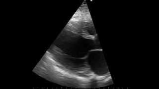 parasternal long axis echo of a patient with dilated cardiomyopathy [upl. by Kristal]