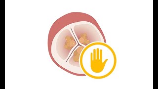 Prophylactic antibiotic treatment to prevent infective endocarditis [upl. by Fortna125]