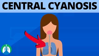 Central Cyanosis Medical Definition  Quick Explainer Video [upl. by Adnamra821]