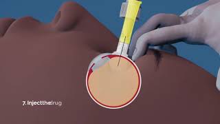 Salar Surgical SPEYE  Animated Product Demo [upl. by Eityak]