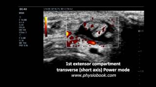 De Quervains tenosynovitis  MSK ultrasound [upl. by Chad284]