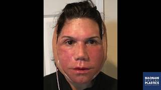 Facelift amp Neck lift Daily healing photos  2 week post op testimonial video [upl. by Kremer]