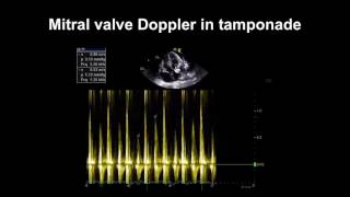 Echocardiography Essentials Detecting pericardial effusions [upl. by Giliana]