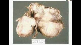 HistopathologyBrain Meningioma [upl. by Lebatsirc]