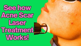 how to get rid of acne scars acnescars acnescarremoval [upl. by Tabatha]