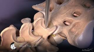 Interlaminar Approach for Discectomy Procedures [upl. by Griggs]