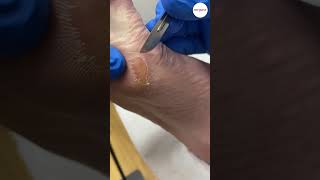 Bunion Callus Removal By Podiatrist [upl. by Meggy489]