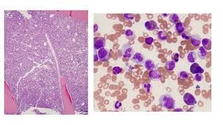 Dr Sanam Loghavi teaches how to confirm diagnosis after bone marrow biopsy [upl. by Laughry177]