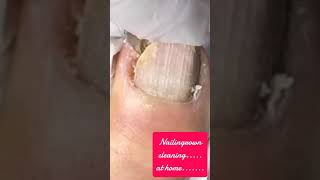 cleaning nail fungus at home [upl. by Elletnuahs]