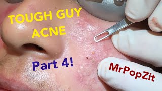 Tough Guy Acne part 4Acne extractionsMake an appointment with me details in description Lets go [upl. by Nadda]