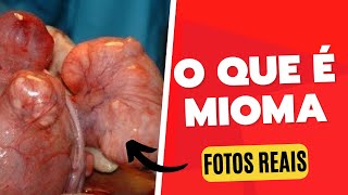 O que é MIOMA e o que causa [upl. by Flemings]