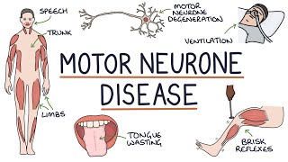 Understanding Motor Neurone Disease Amyotrophic Lateral Sclerosis [upl. by Atteval165]