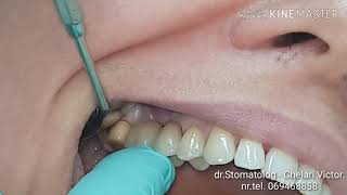 Stomatologie ChisinauBotanicaTerraDent Moldova Diferenta dintre implant dentar si dinte natural [upl. by Eltsyrhc652]