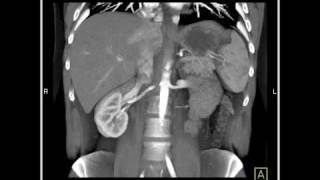 Abdomen Liver CT Angiography with 3D Mapping demonstrates an AVM in the liver [upl. by Nyl330]