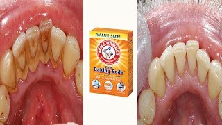 How to Remove Plaque amp Tartar from Teeth with Baking Soda at Home [upl. by Analihp318]