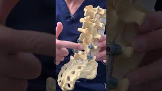 Know more about Pedicle Screws [upl. by Ahsienroc]