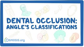 Dental occlusion  Angle’s classifications [upl. by Leventhal663]