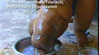 Elephantiasis Afflicts 120 Million in Africa Asia [upl. by Earej]