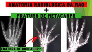 Anatomia radiológica da mão  Fratura de metacarpo  Anatomia da mão no RaioX  Medicina Geral [upl. by Gervais]