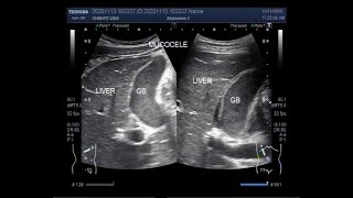 Ultrasound Video showing Gallbladder sludge and Mucocele of the Gallbladder [upl. by Zosema184]