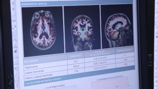 Introduction to CorTechs Labs and NeuroQuant [upl. by Annoyek53]