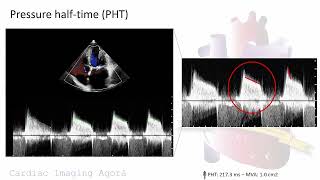 Evaluation of rheumatic mitral stenosis with advanced transthoracic echocardiography [upl. by Loydie121]