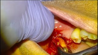 6 Extraction of abscessed molar [upl. by Mozza298]