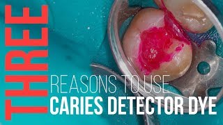 3 Reasons to Use Caries Detector Dye [upl. by Blodget]