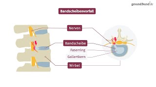 Top Uebungen bei Bandscheibenvorfall im Rücken [upl. by Entwistle]