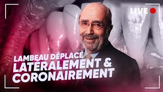 En Direct  🔴 Lambeau déplacé latéralement amp coronairement 🦷 [upl. by Belmonte]