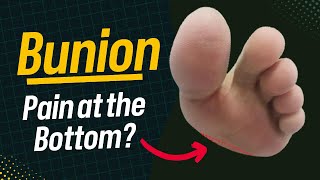 BunionRelated Metatarsal Pain Quick Fix [upl. by Packston]