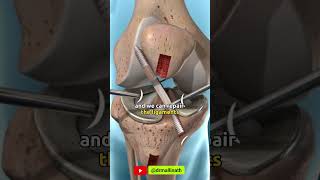 What are the advantages of an arthroscopic surgery  shprts [upl. by Anod285]