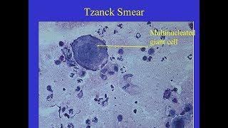 Tzanck smear Positive [upl. by Humphrey]