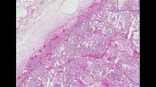 Histopathology Lung Lobar pneumonia [upl. by Ayita]