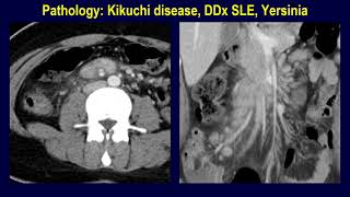 Necrotizing histiocytic lymphadenitis KikuchiFujimoto disease of abdomen [upl. by Sivet]