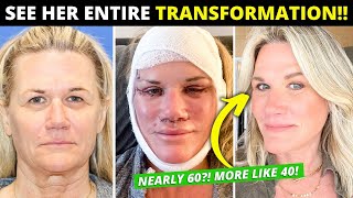 Facelift at Nearly 60 Changes Her Entire Life Dramatic Vertical Restore Surgery BeforeAfter [upl. by Jacobsohn987]