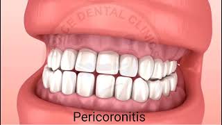 What is Pericoronitis When is Operculectomy Brace Dental Clinics [upl. by Adlesirk]