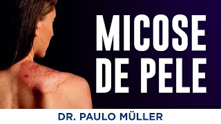 Micoses de Pele – Dr Paulo Müller Dermatologista [upl. by Ferriter]