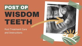 What Are the Rules After Wisdom Teeth Removal Post Treatment Care from Wisdom Teeth Extraction [upl. by Lednem]